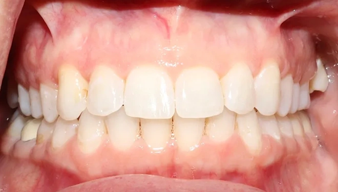 ClearCorrect treatment after photo showing a straighter, more even smile