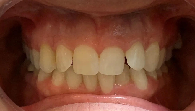 ClearCorrect treatment before photo showing crowded and misaligned teeth