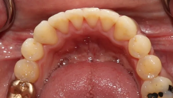Upper dental arch after ClearCorrect with improved tooth alignment