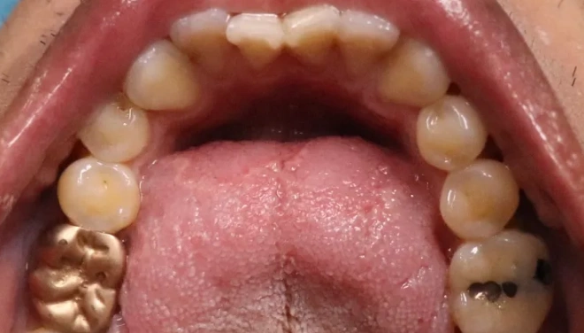 Upper teeth before ClearCorrect showing crowding and irregular spacing