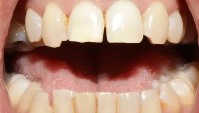 Front teeth before composite bonding with visible gaps and damaged areas