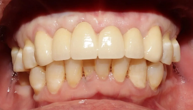 Fixed anterior bridge restoring the appearance of the front teeth