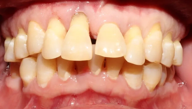 Front teeth before bridge treatment with missing and damaged teeth
