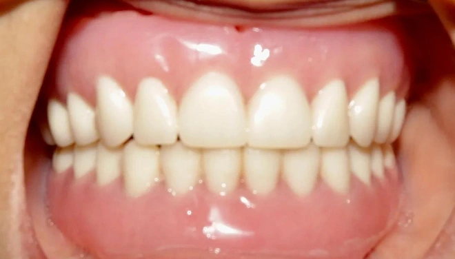 Restored upper and lower arches with a bright, uniform set of teeth