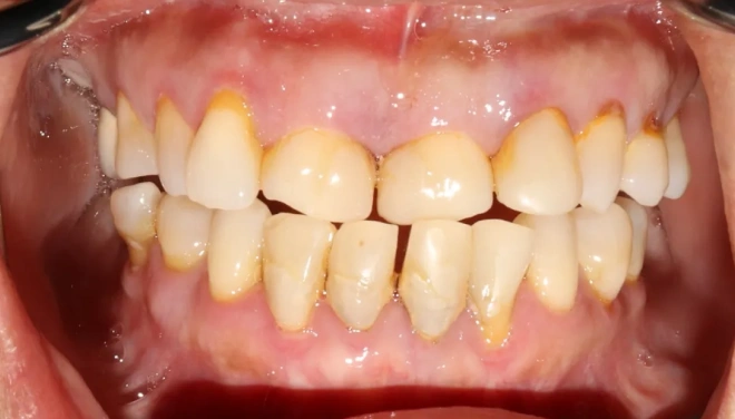 Before dentures showing severely worn and compromised natural teeth