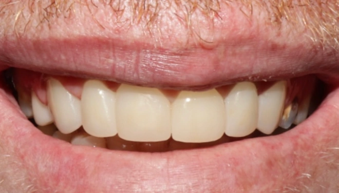 Finished upper and lower dentures creating a complete natural-looking smile