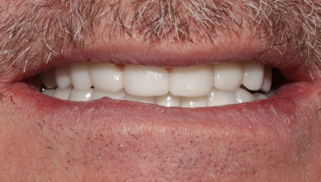 Completed upper denture creating a full row of natural-looking teeth