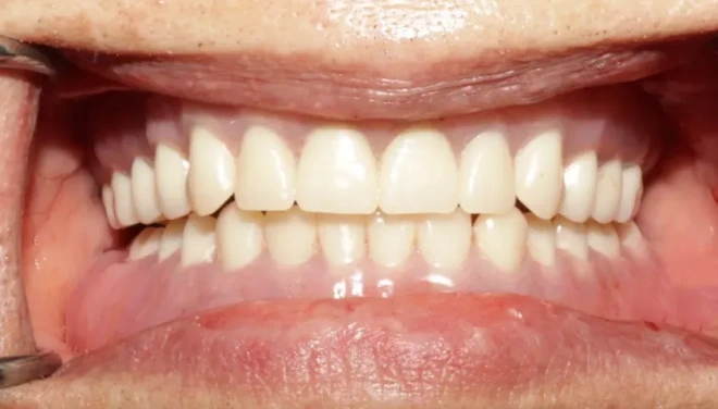 Upper and lower dentures providing a complete and even smile
