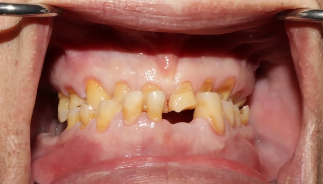Upper and lower teeth before denture treatment with extensive wear and damage