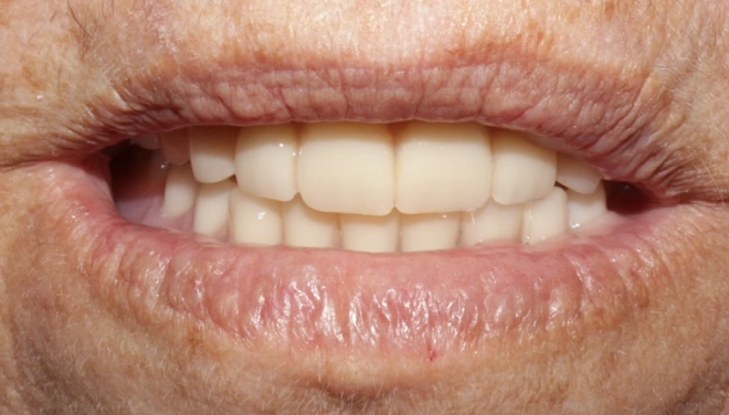 Completed full dentures visible in a close-up smiling mouth