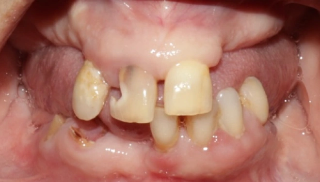 Natural teeth before full denture treatment with multiple damaged areas