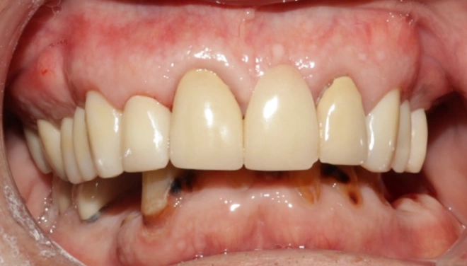 Denture restoration showing complete upper and lower rows of teeth
