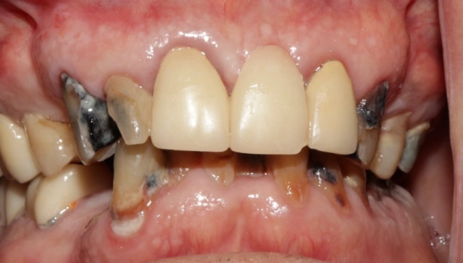 Teeth before restoration showing extensive decay, damage, and missing areas