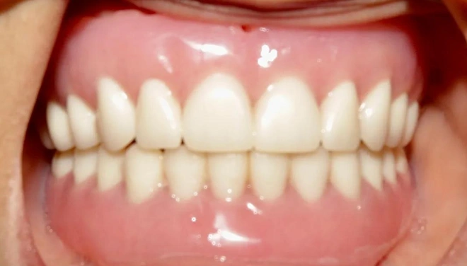 Restored denture smile with symmetrical upper and lower teeth