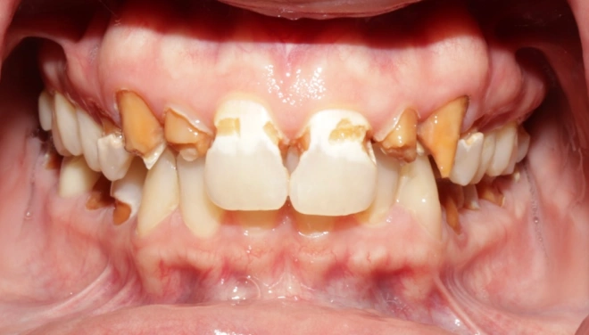 Smile before denture treatment showing heavily damaged front teeth