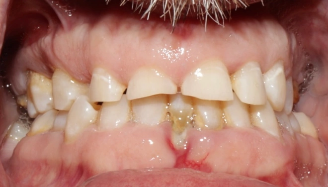 Upper teeth before full denture treatment with severe tooth loss and damage