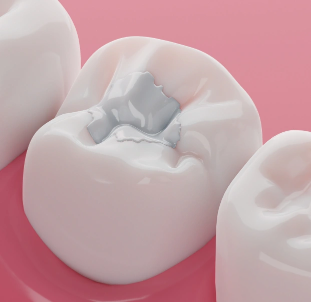 Illustration of a tooth restored with a composite filling