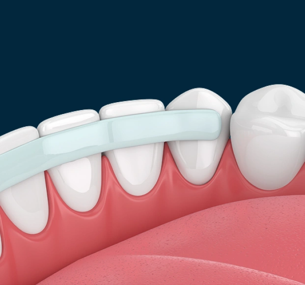 Illustration showing dental bonding material applied to a tooth