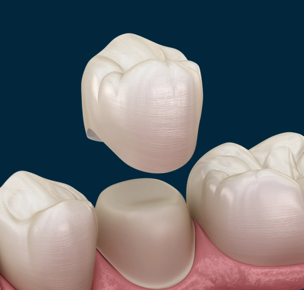Illustration of dental crowns restoring damaged teeth