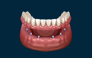 Dental model showing implant-supported dentures