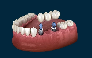 Dental model showing multiple dental implants replacing missing teeth