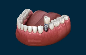 Dental model showing a single dental implant replacing a missing tooth