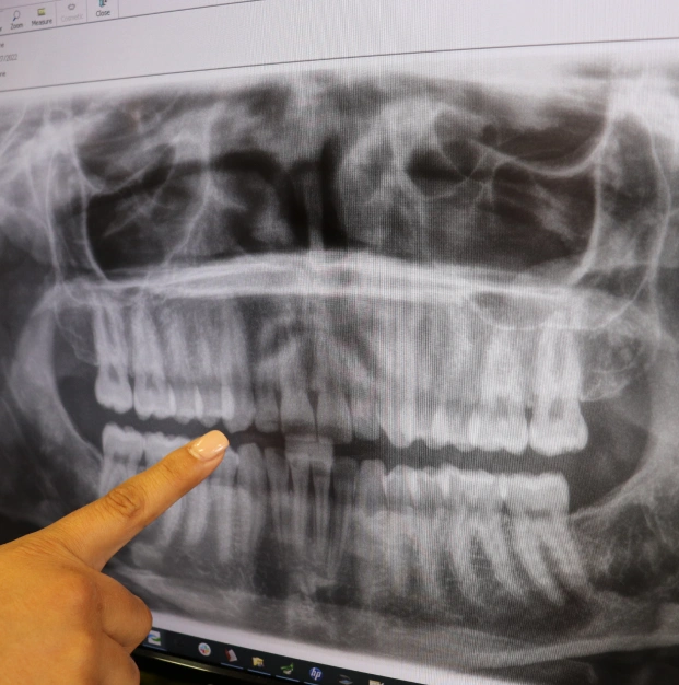 Dental panoramic X-ray showing teeth and jaw