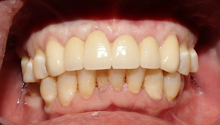 Improved tooth alignment after dental treatment