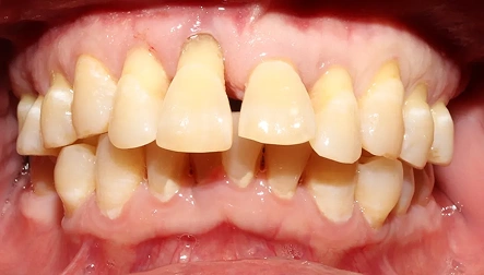 Misaligned teeth before dental treatment