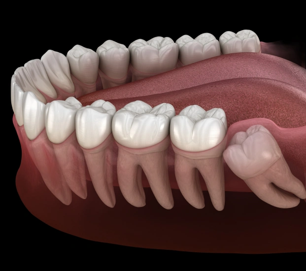 Illustration showing wisdom teeth and their extraction